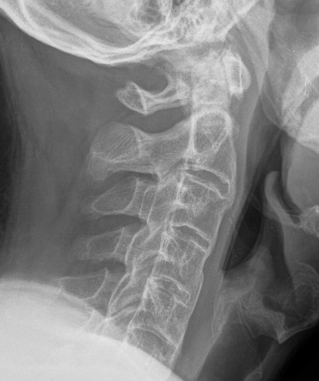 Ankylosing Spondylitis Latera C Spine